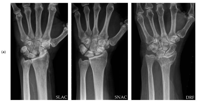 Preoperative PA wrist radiographs of three post-traumatic wrists, labelled SLAC, SNAC and DRF.