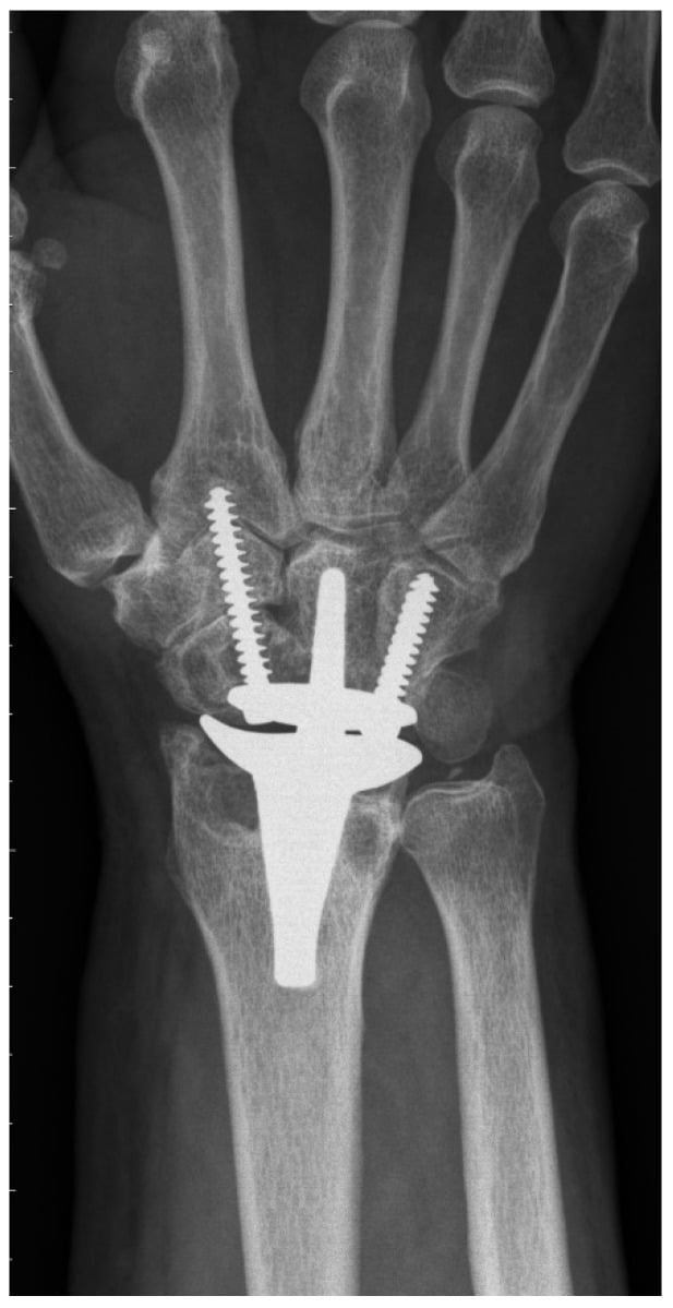 Long-term wrist radiograph showing severe radial impaction after total wrist arthroplasty.