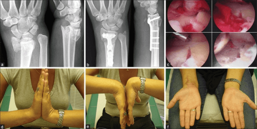 Arthroscopic-assisted fixation of an intra-articular distal radius fracture