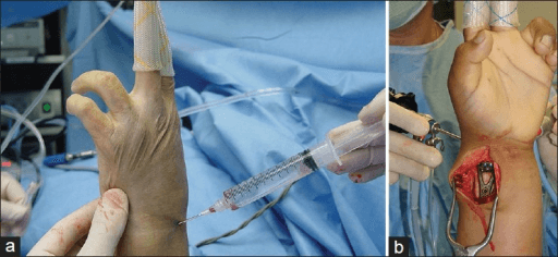 Wrist in traction for arthroscopy with scope insertion