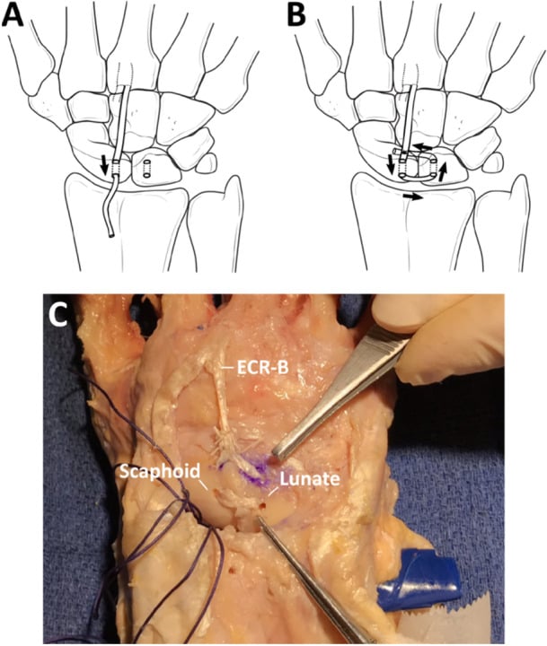Drawings (A, B) and cadaveric view (C) of dorsal transarticular ligament reconstruction with an ECRB graft between scaphoid and lunate