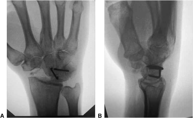 PA (A) and lateral (B) wrist radiographs after scaphoid excision and four-corner fusion