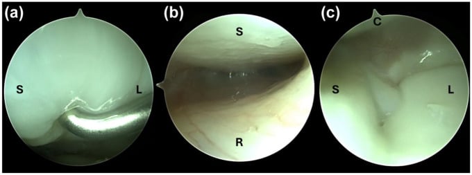 Three arthroscopic views of a Geissler grade II scapholunate lesion: a probe between scaphoid and lunate, the scaphoid over the radius, and the junction of scaphoid, lunate and capitate