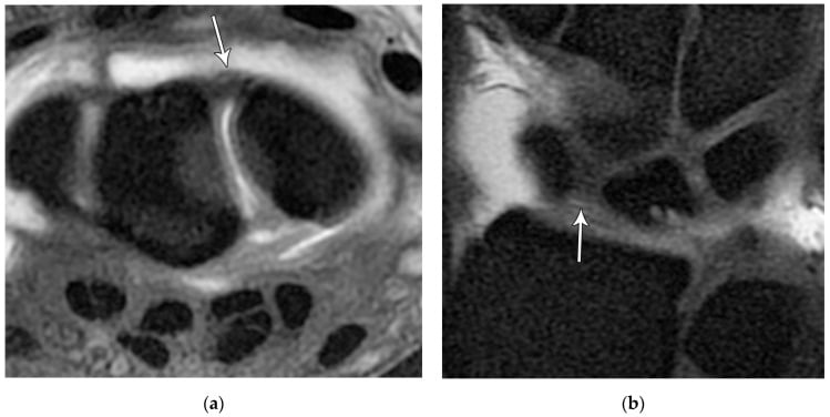 Normal MR arthrogram, axial (a) and coronal (b) images, with arrows on the dorsal scapholunate ligament