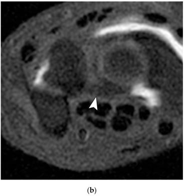 Axial MR arthrogram (panel b) with an arrowhead on the normal volar lunotriquetral ligament