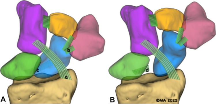 Three-dimensional schematic of the scaphoid ligament stabilisers, lettered a to d, in an intact wrist (A) and after scapholunate failure (B)