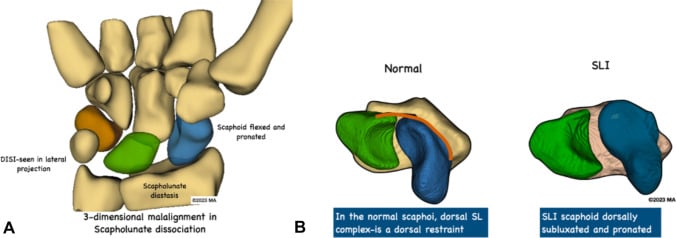 Three-dimensional schematics of scapholunate dissociation: panel A labelled scaphoid flexed and pronated, scapholunate diastasis and DISI; panel B comparing the normal dorsal scapholunate restraint with dorsal subluxation and pronation of the scaphoid