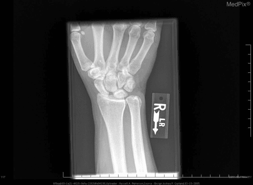 PA wrist radiograph with scapholunate widening