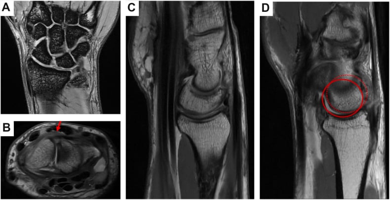 MRI panels A to D, coronal, axial and sagittal, showing scapholunate ligament disruption with a red arrow in B and red circles in D