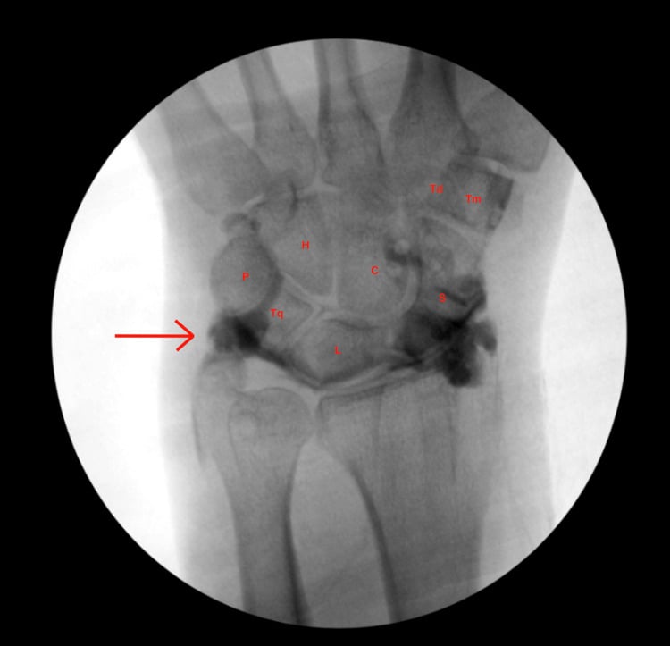 Fluoroscopic wrist arthrogram with labelled carpal bones and a red arrow at contrast beside the triquetrum