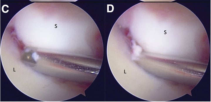 Arthroscopic views C and D showing a shaver passing into the interval between scaphoid and lunate in drive-through instability