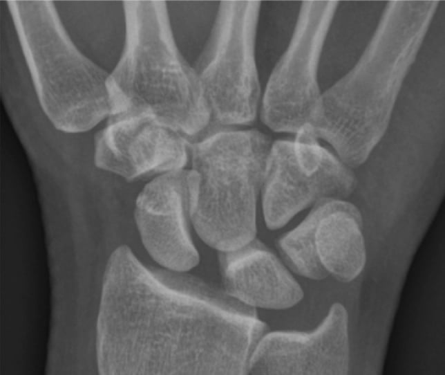 PA wrist radiograph showing a widened scapholunate interval and a cortical ring in the flexed scaphoid