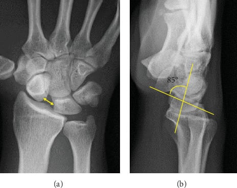 PA radiograph with a yellow arrow across a widened scapholunate interval (a) and lateral radiograph with an 85-degree scapholunate angle drawn (b)