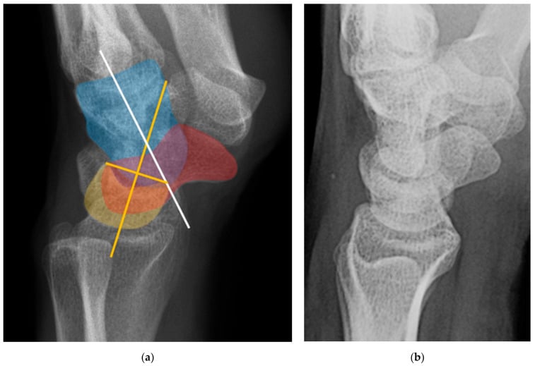 VISI classification pattern lateral wrist radiograph