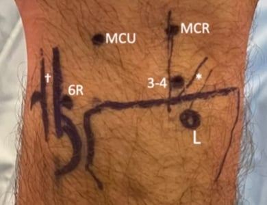 Dorsal wrist surface markings with the 3-4, 6R, MCR and MCU arthroscopy portals and Listerβs tubercle (L) labelled