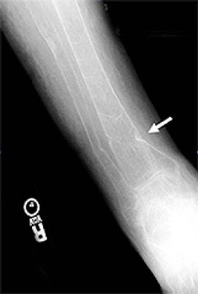 AP radiograph of the tibia and fibula with an arrow pointing to a Looser-zone pseudofracture