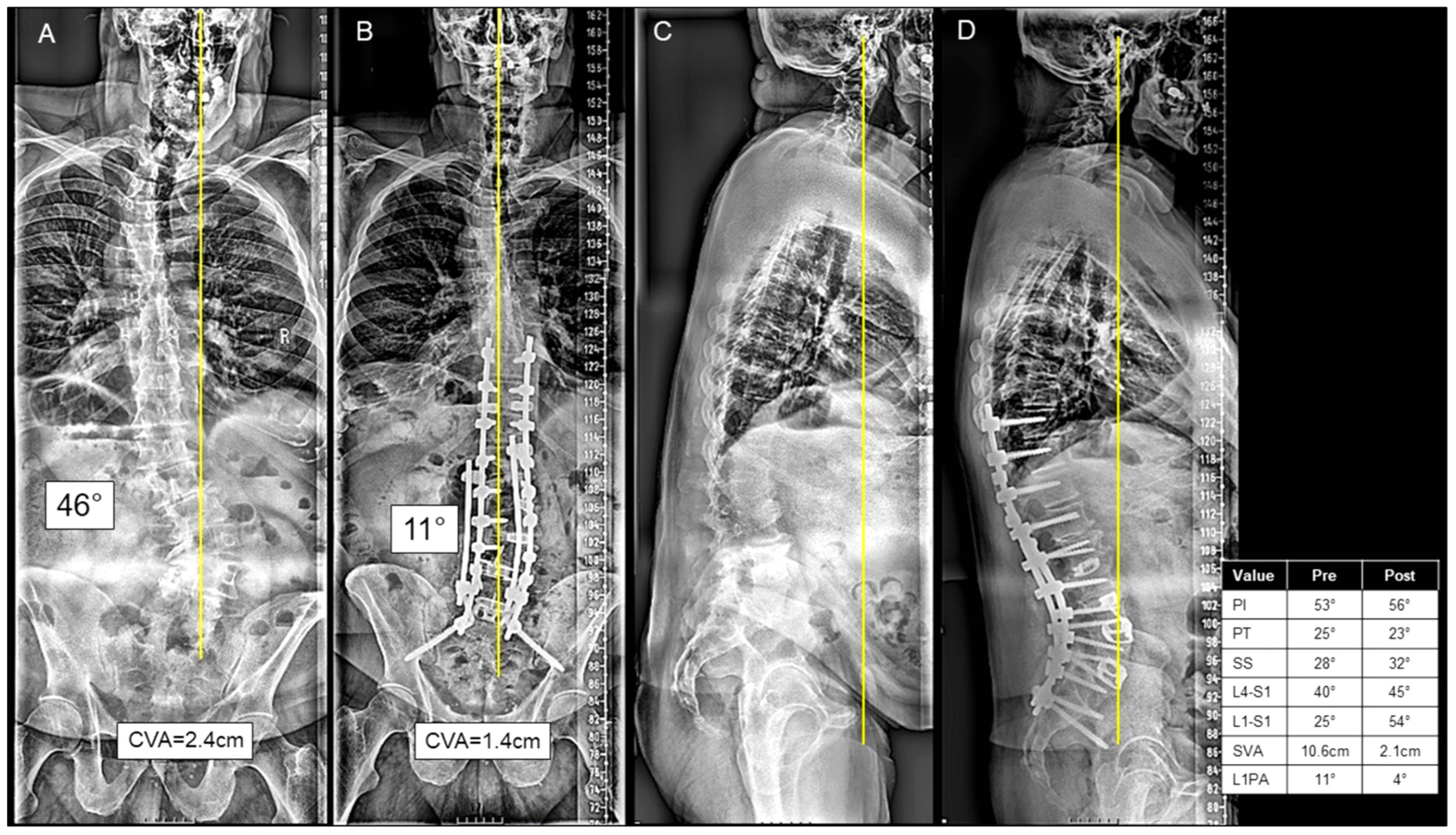 Preoperative and postoperative adult spinal deformity full-length radiographs β Credit: J Clin Med / MDPI (Journal of Clinical Medicine / MDPI), CC BY
