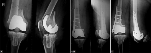 Periprosthetic distal femur fracture with locking plate fixation — Credit: Open-i (NIH), CC BY