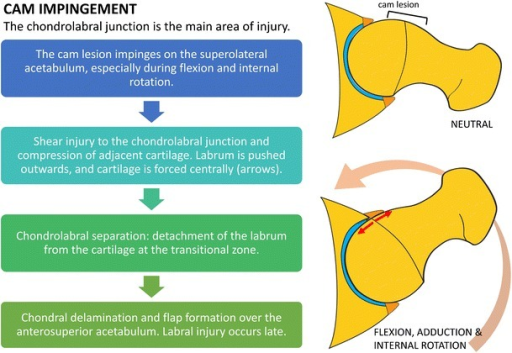 MRI for the preoperative evaluation of femoroacetabular impingement — Credit: Li AE et al. via Insights Imaging (Open-i (NIH)), CC BY