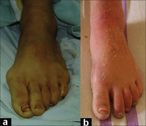 Two-panel foot photographs showing hallux valgus pre and post operative correction β Credit: Baba AN et al. via Indian J Orthop (Open-i (NIH)), CC BY