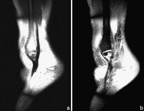Two-panel coronal MRI showing ankle ligament reconstruction with tendon graft — Credit: Via Open-i (NIH), CC BY