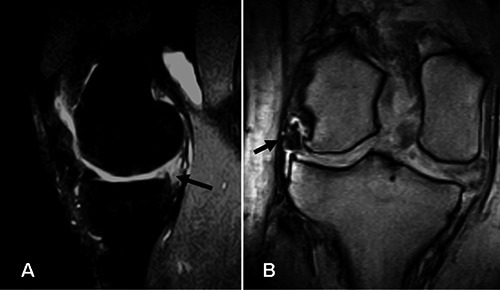Meniscal root tear repair technique illustration or image — Credit: Bonasia DE et al. via Orthop Rev (Pavia) (Open-i (NIH)), CC BY