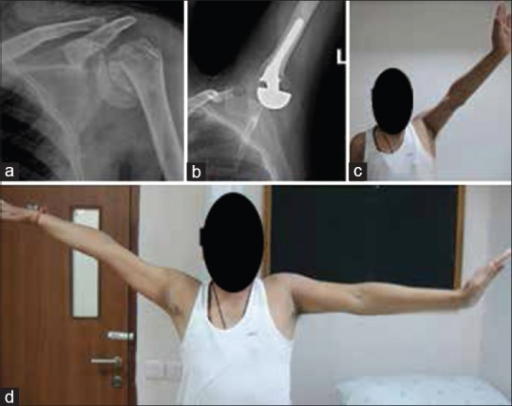 X-rays after hemiarthroplasty for three or four part proximal humerus fracture — Credit: Open-i / NIH (Open-i (NIH)), CC BY
