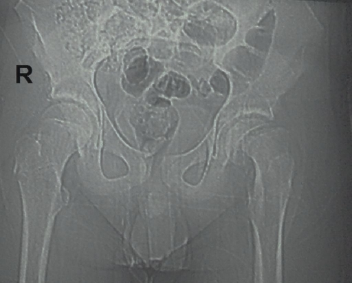 Radiograph of slipped capital femoral epiphysis in adolescent patient — Credit: Solduk L et al. via J Clin Med Res (Open-i (NIH)), CC BY
